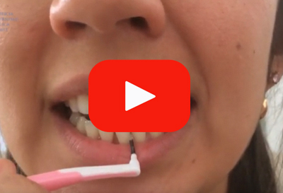 dental cepilladointerproximal video copia